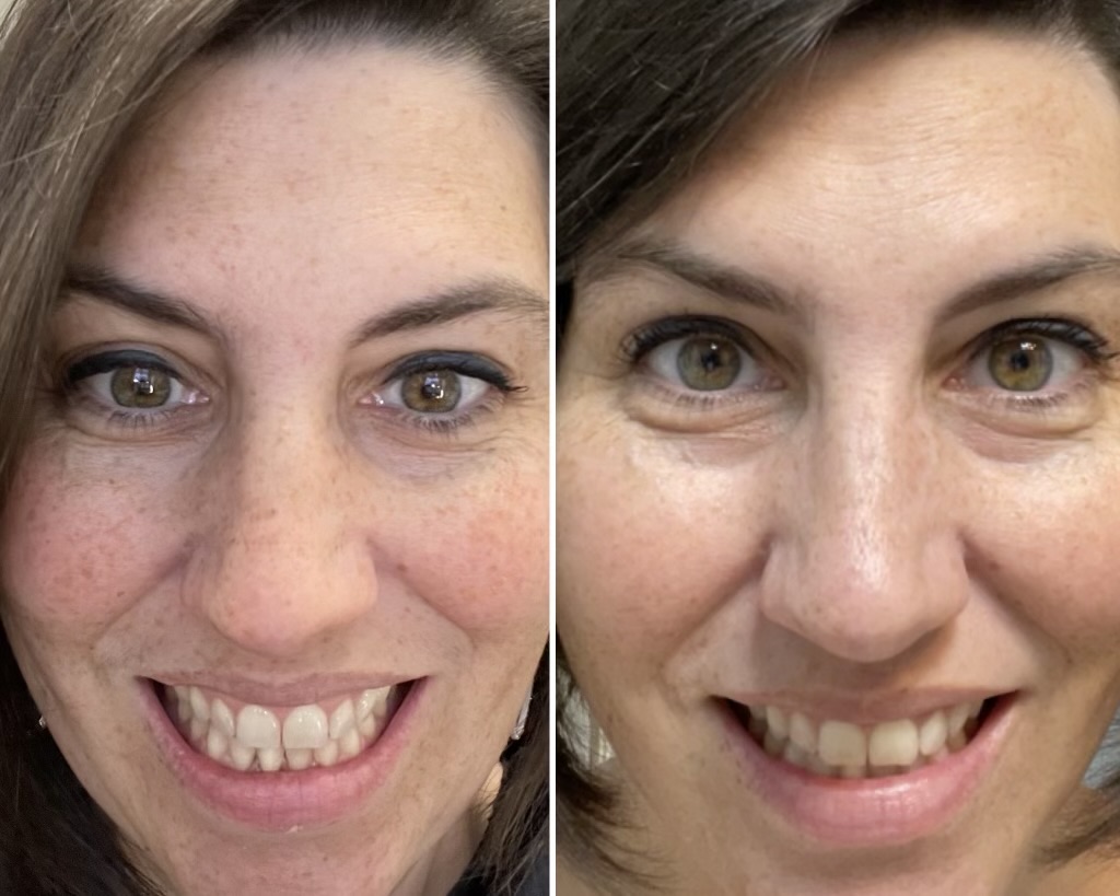 Before and After Image: IPL Photofacial for Melasma - front