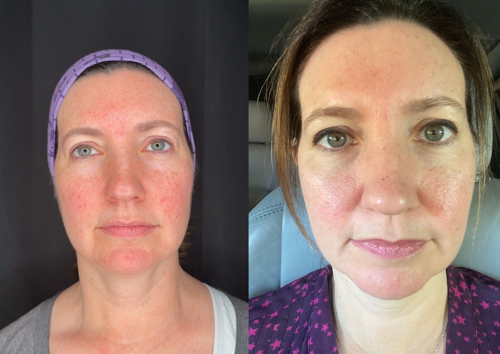 Before and After Image: IPL Photofacial for Rosacea - front