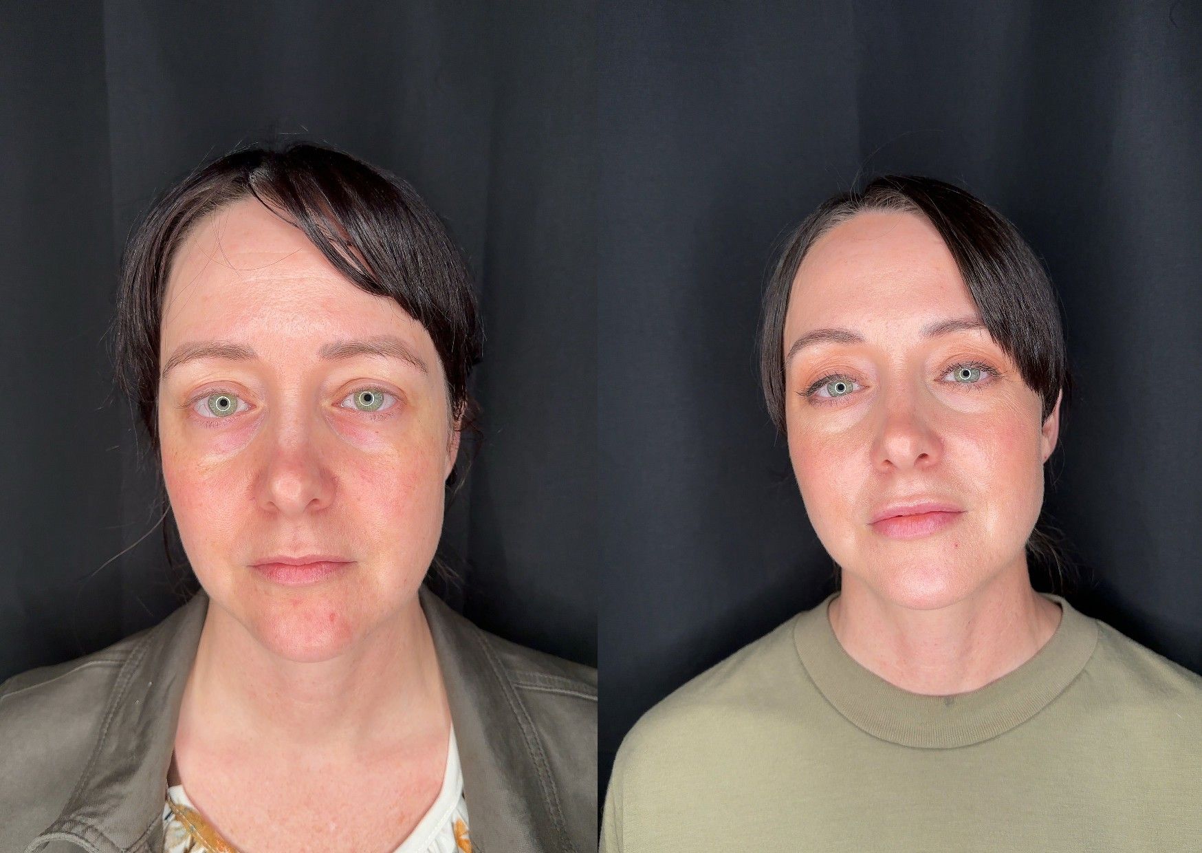 Before and After Image: Microneedling, IPL Photofacial, Dermal Filler in Midface and Lips, Neurotoxin - front