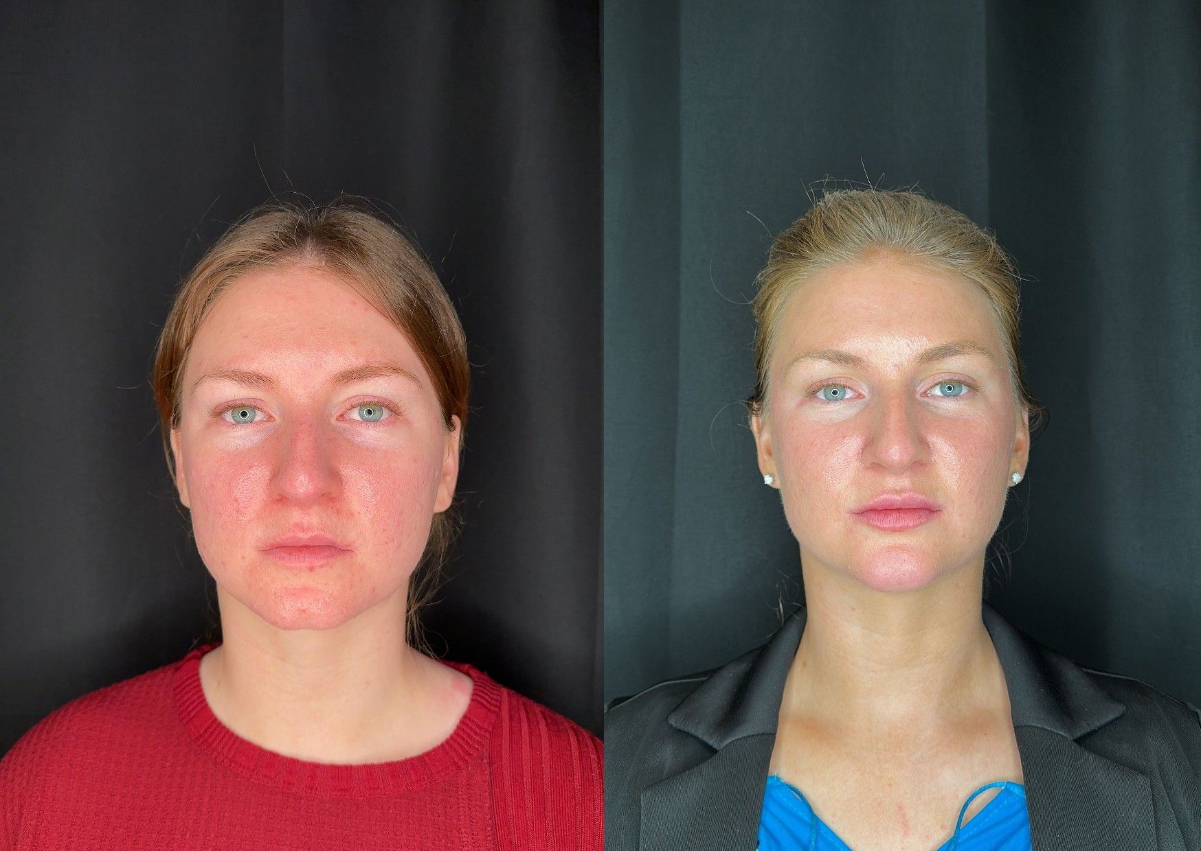 Before and After Image: Microneedling, VI Peel Chemical Peels, Dermal Filler in Chin and Lips - front