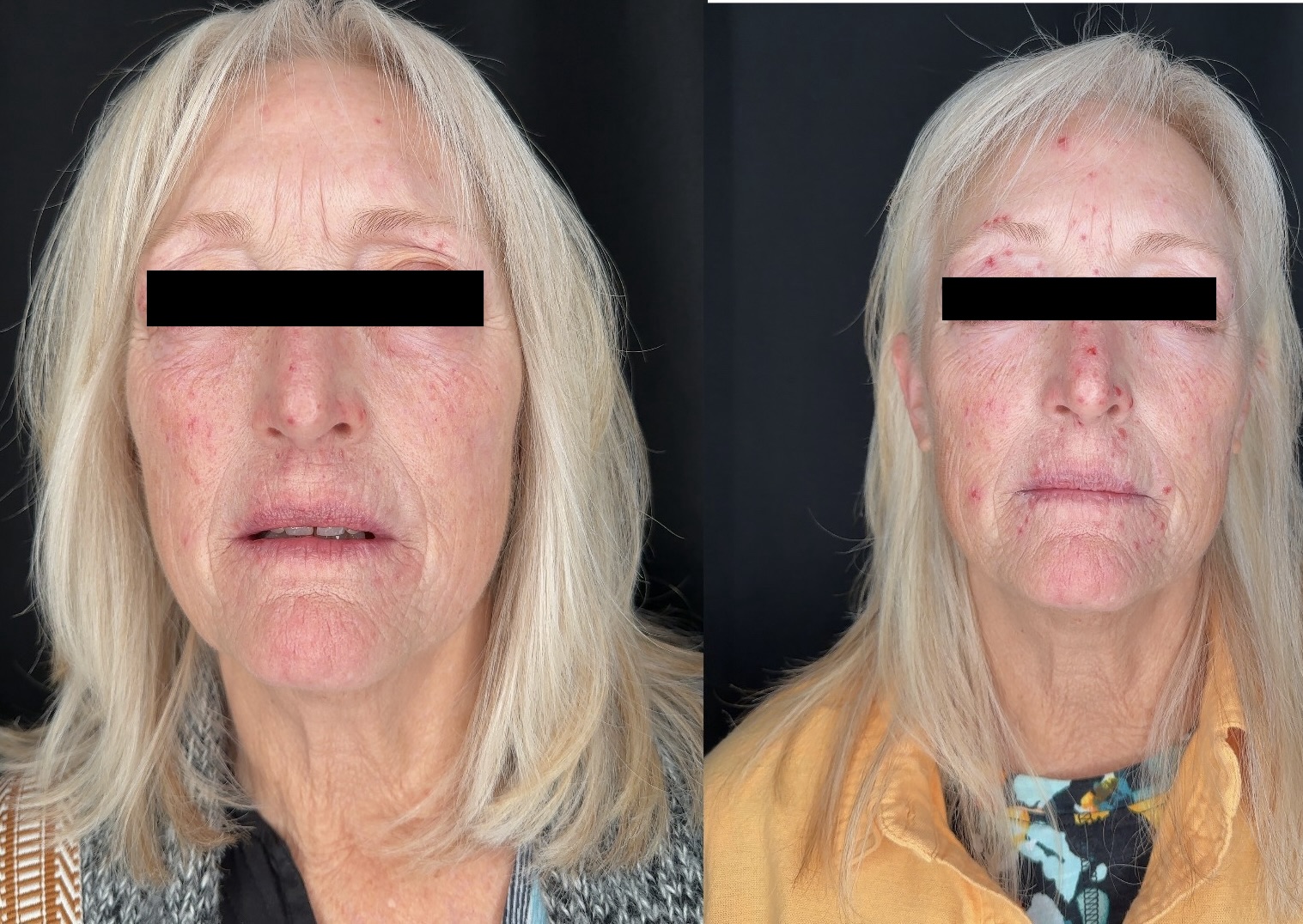 Before and After Image: Peak Medical-Grade Skincare - front