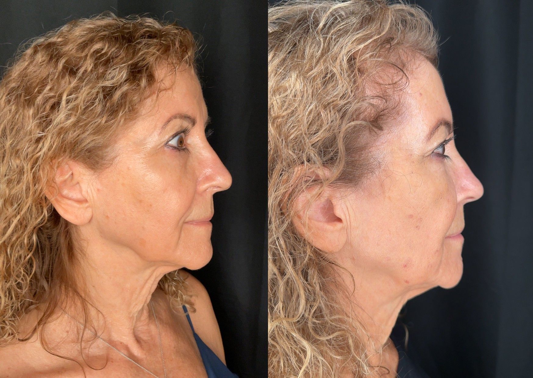 Before and After Image: Re-Lift Protocol RF Skin Tightening on Lower Face - right-side
