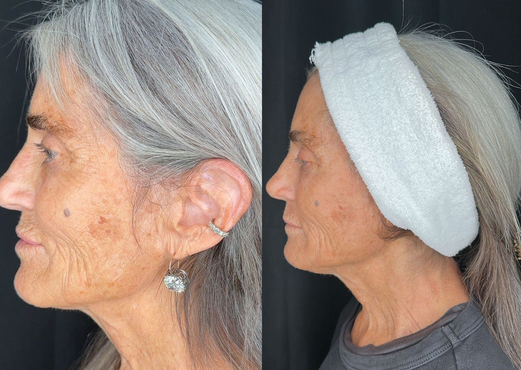Before and After Image: Single CO2 Laser Resurfacing - left-side