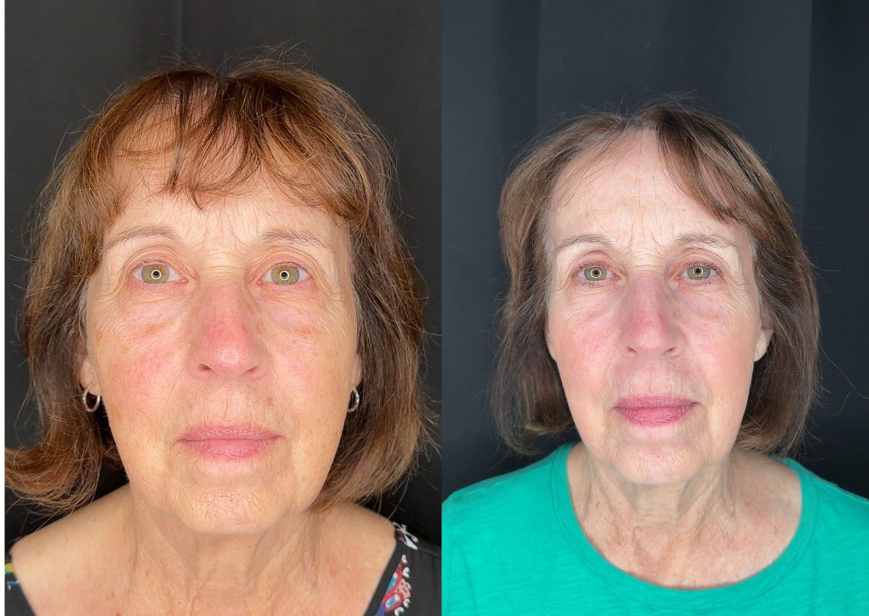 Before and After Image: Single CO2 Laser Resurfacing - front