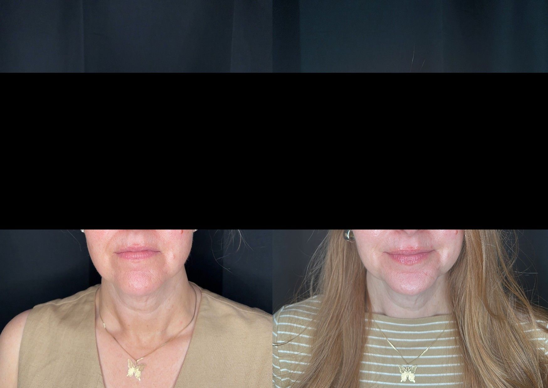 Before and After Image: V-ST for Lip Plumping - front