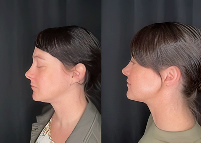 Before and After Image: Microneedling, IPL Photofacial, Dermal Filler in Midface and Lips, Neurotoxin - left-side